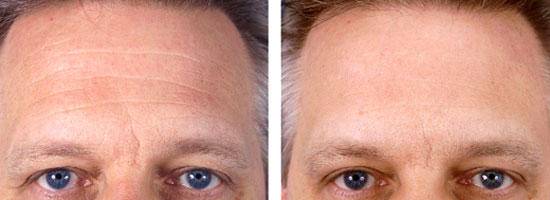 为什么抬头纹显得人这么老,多年的抬头纹怎么解决