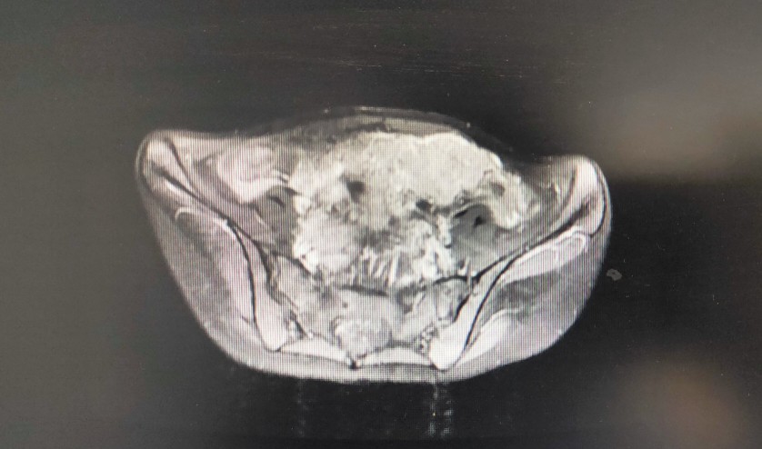 女子子宫内膜癌,22岁子宫内膜癌
