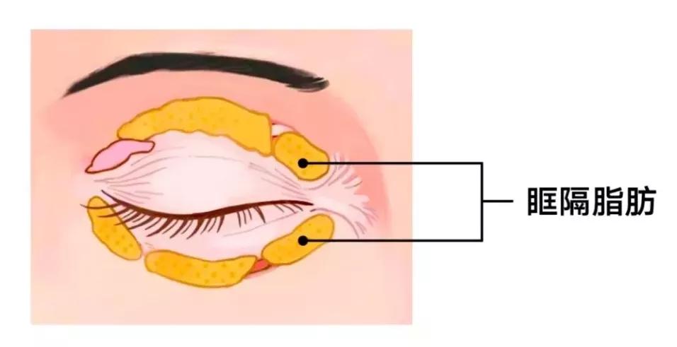 治眼袋三个小妙招快速去眼袋,上眼袋大最简单的去眼袋的方法