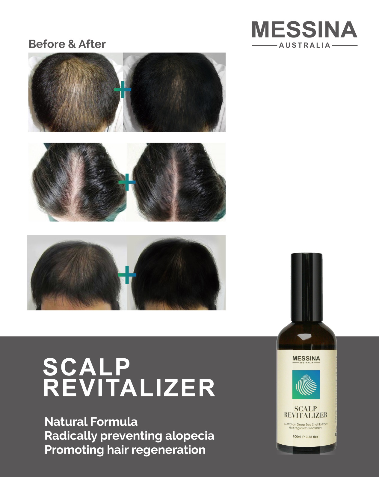 脱发脱成灭霸，我加入了妇愁者联盟！澳洲messina带你找回自信