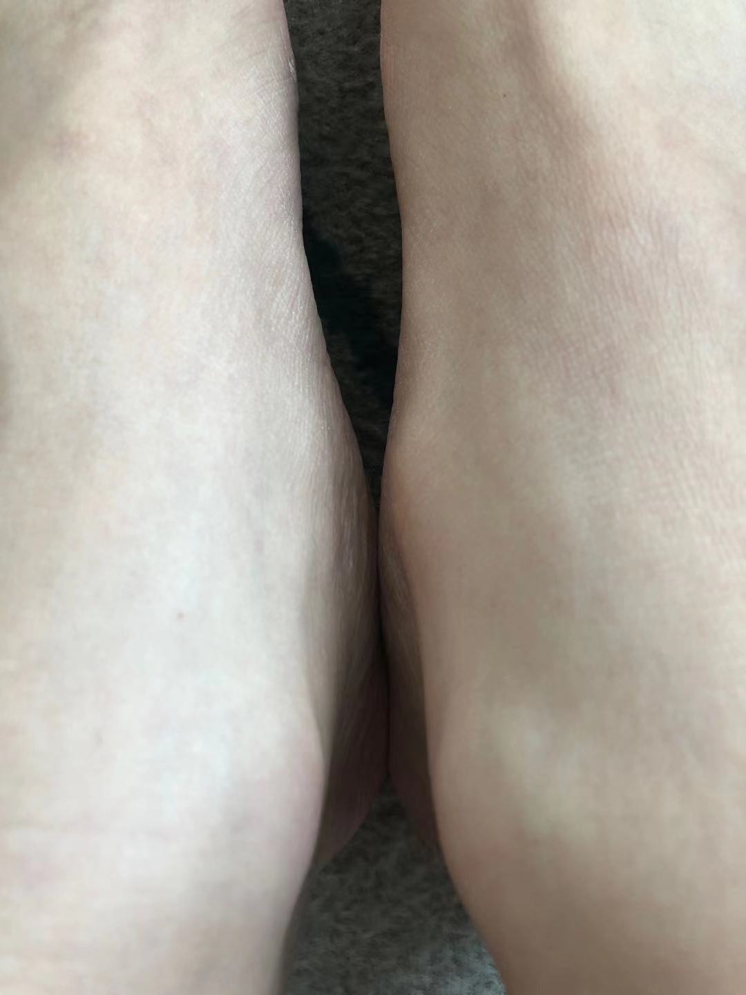 副舟骨突出和崴脚有关系吗,崴脚崴到副舟骨疼痛怎么缓解