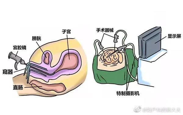 有什么合理的理由可以选择剖腹产,选择剖腹产会经历什么