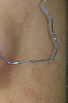 不割不埋线的双眼皮纳米技术,纳米无痕双眼皮和非手术区别