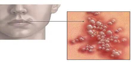 辟谣23名男女感染h7n9死亡评论,男性疾病辟谣