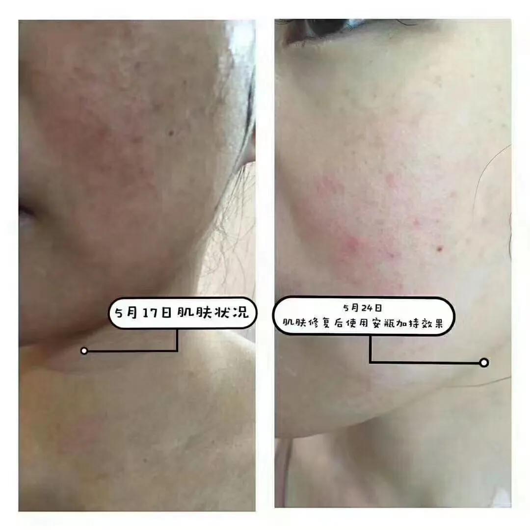 为什么会长痘痘要查激素,为什么会长痘痘