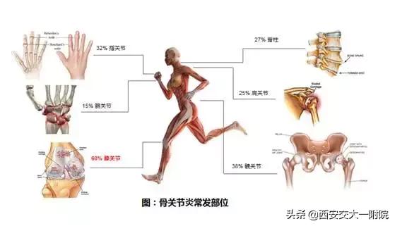 中老年骨性膝关节炎的最好治疗,骨关节是中老年残疾第一大杀手