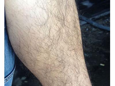 女生汗毛又多又长自卑怎么办,医生教你怎么去除体毛