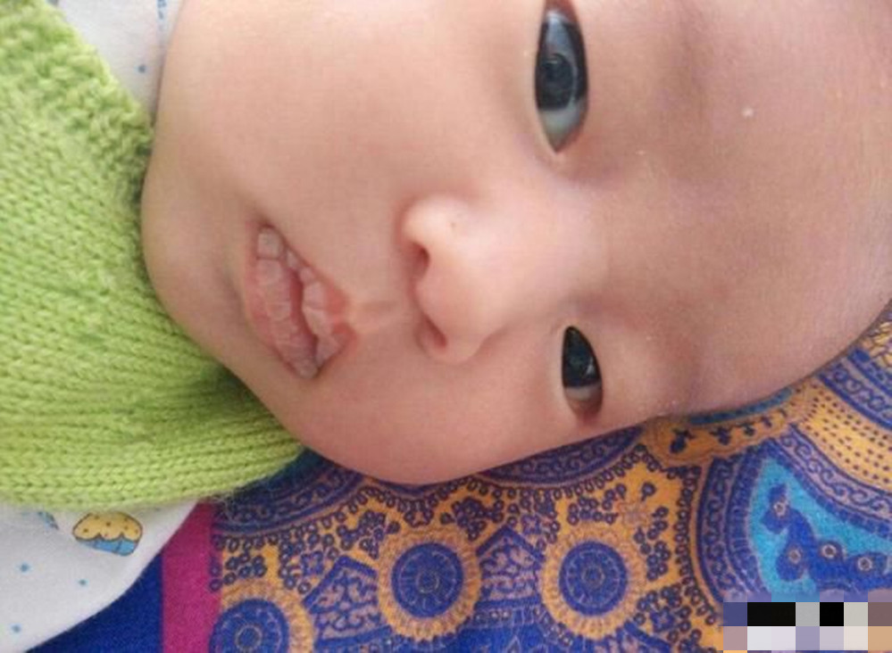 新生儿嘴唇上的奶泡多久可以脱落,新生儿上下嘴唇都有奶泡怎么办