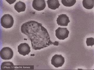 细菌感染感冒看血常规哪个指标,血常规检查判断细菌还是病毒感冒