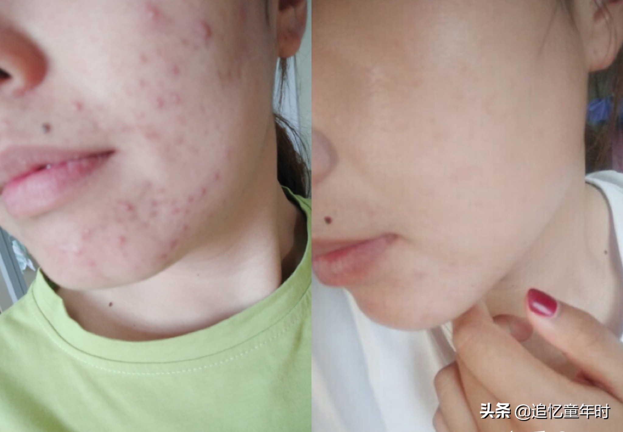 怎么可以让痘印快点消失,有什么办法让痘印消失