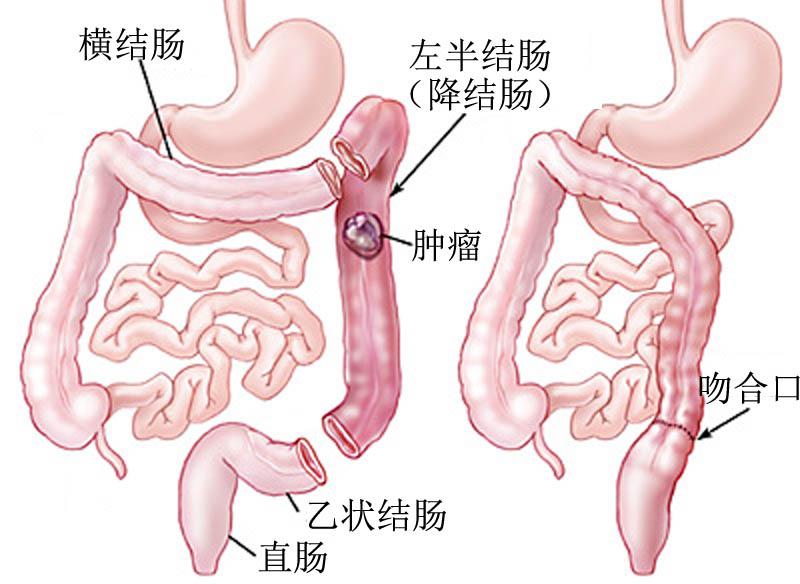 结肠癌常见的手术方式有哪些？