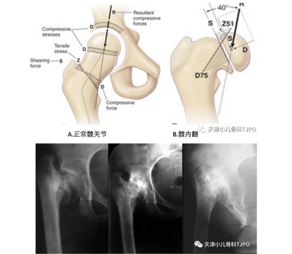 儿童髋外翻怎么治疗,儿童髋内翻是什么原因