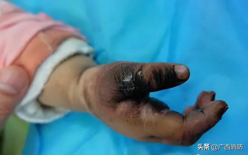 小学生一个动作吓坏全世界,孩子手被电烧黑怎么处理