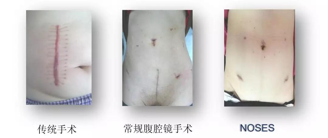 直肠癌的常用手术方式及其适应症,直肠癌手术的风险大吗