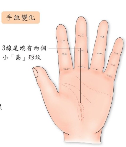 手诊子宫肌瘤手部反射区,大拇指上的穴位治子宫肌瘤