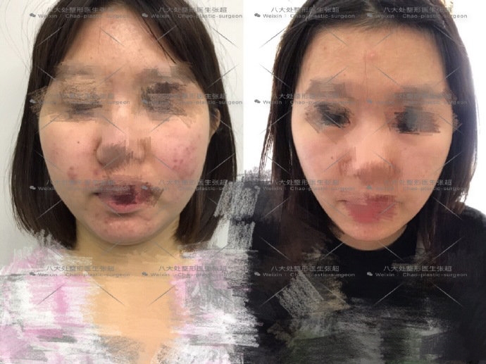 八大处整形张超,八大处张超最新视频