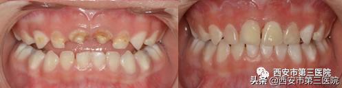 预成冠儿童乳牙内收钳怎么用,乳牙金属预成冠有必要做吗