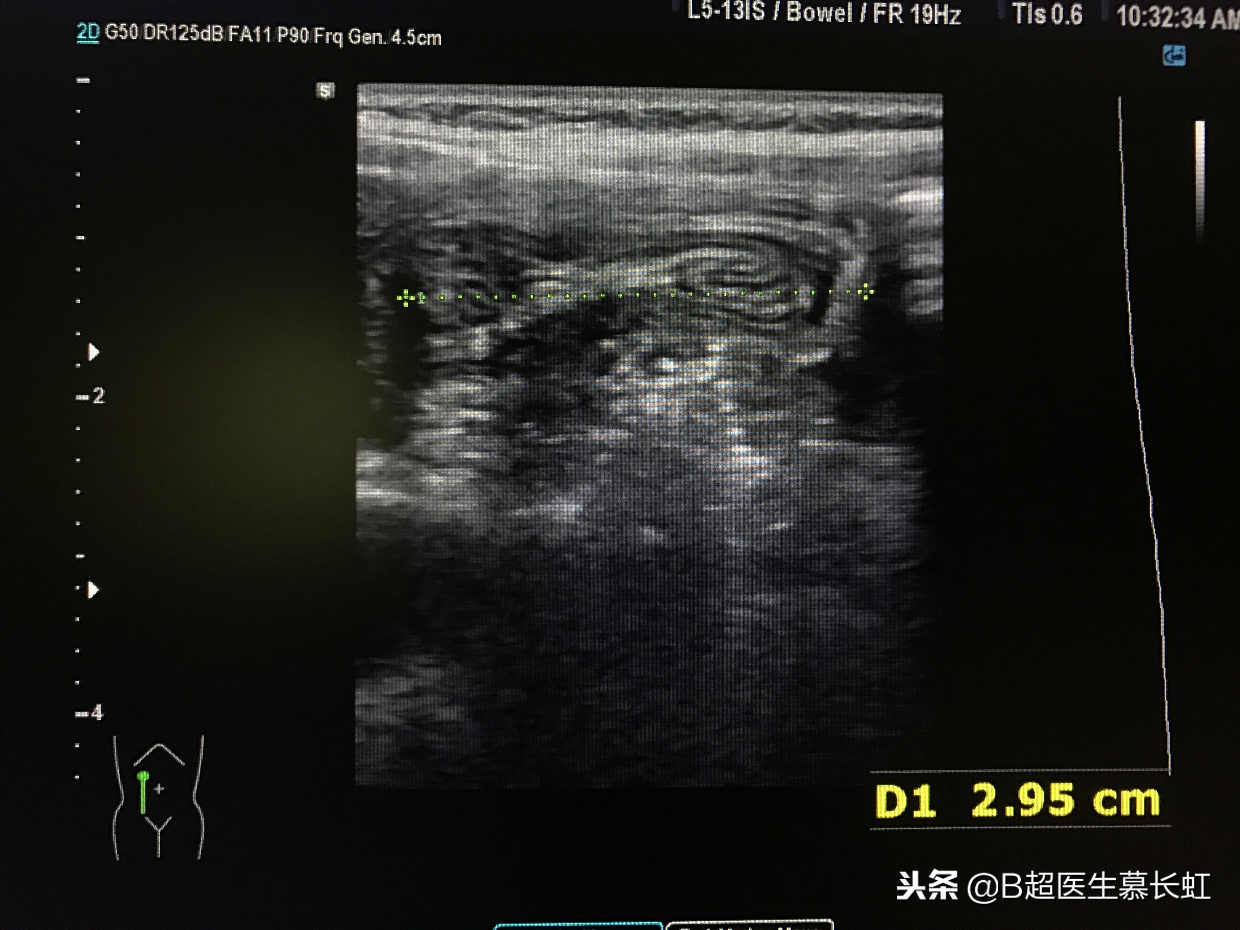 儿童肚子疼呕吐拉血怎么回事,2岁宝宝说肚子痛肠套叠