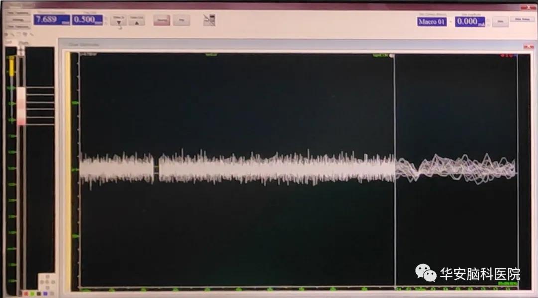 梅杰氏综合征dbs手术成功率,梅杰综合征微创手术打几个孔