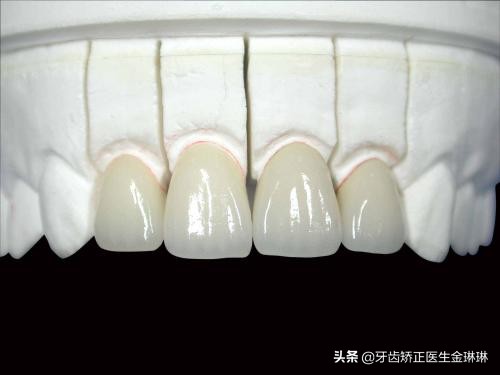 牙医说装烤瓷牙冠,牙医做牙冠疼吗
