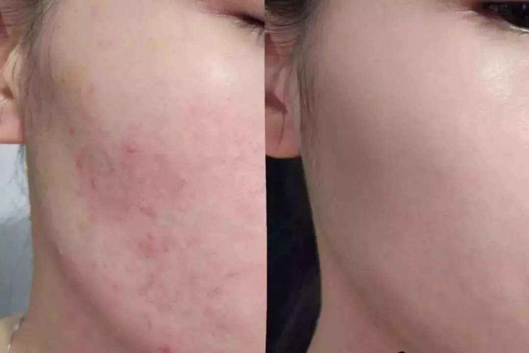 全球公认最好的10款祛痘膏,超好用的一款祛痘膏