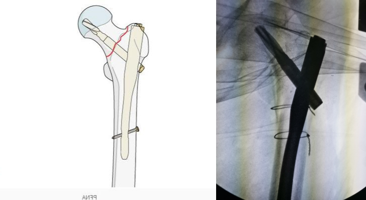 老人摔一跤屁股骨折,老人一屁股坐在地上大腿骨折