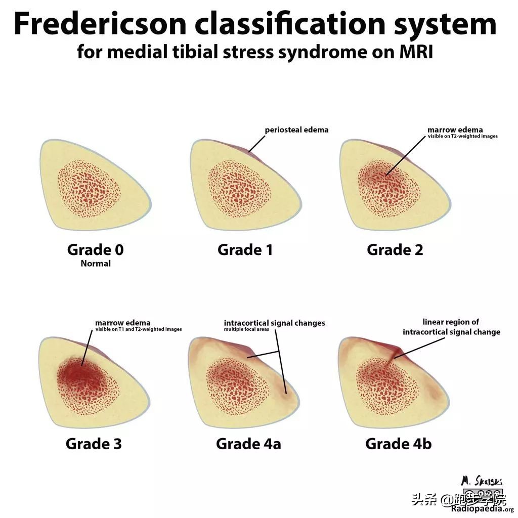 伤害了1/3跑者的胫骨炎，请务必重视起来