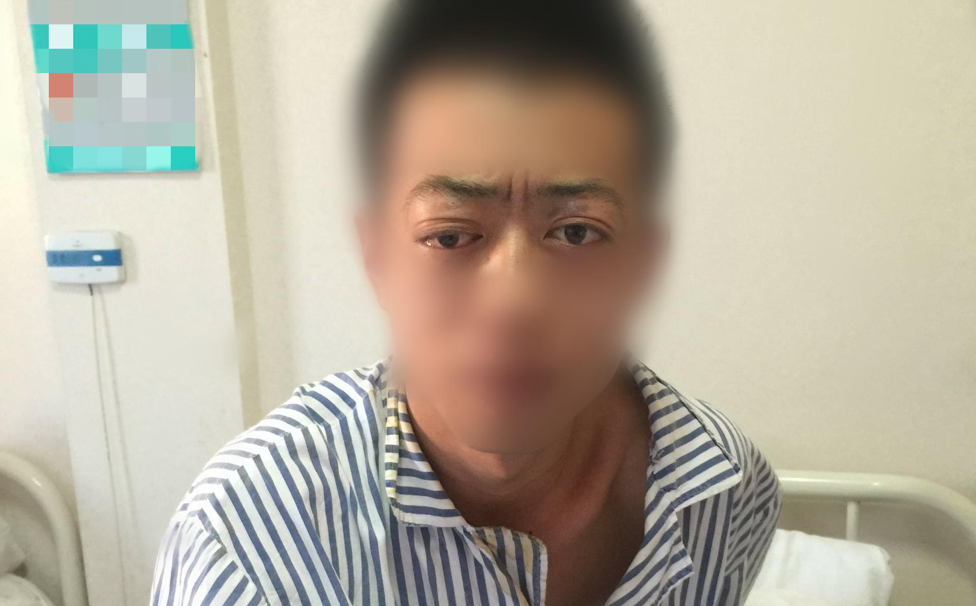 甲亢碘131治疗亲身经历,从甲亢到甲减的最典型症状表现