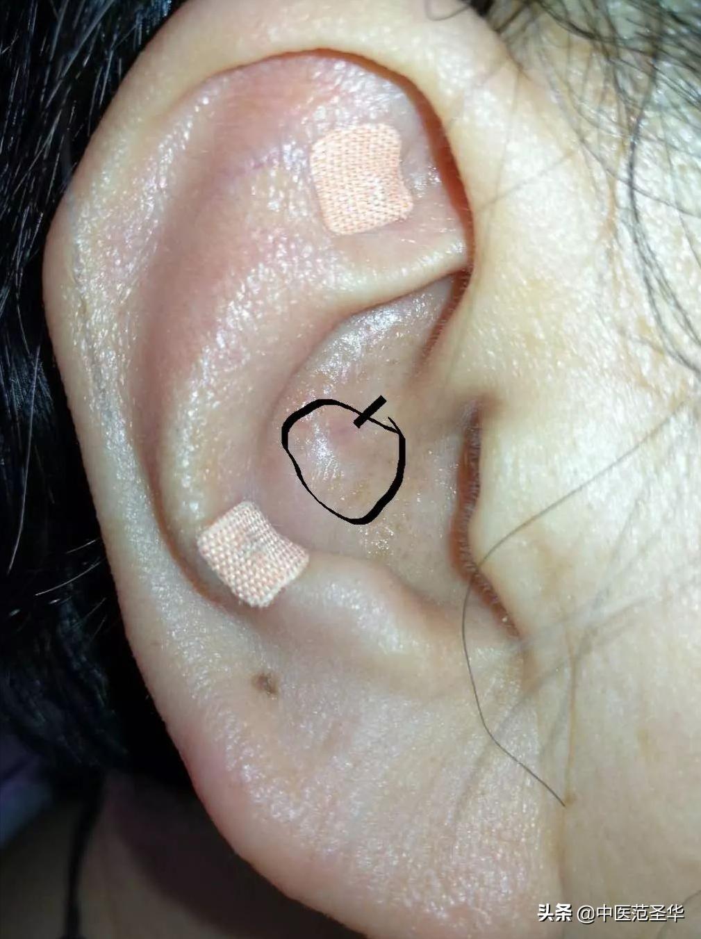 耳朵边缘有凹陷什么原因,耳朵上有凹陷代表什么