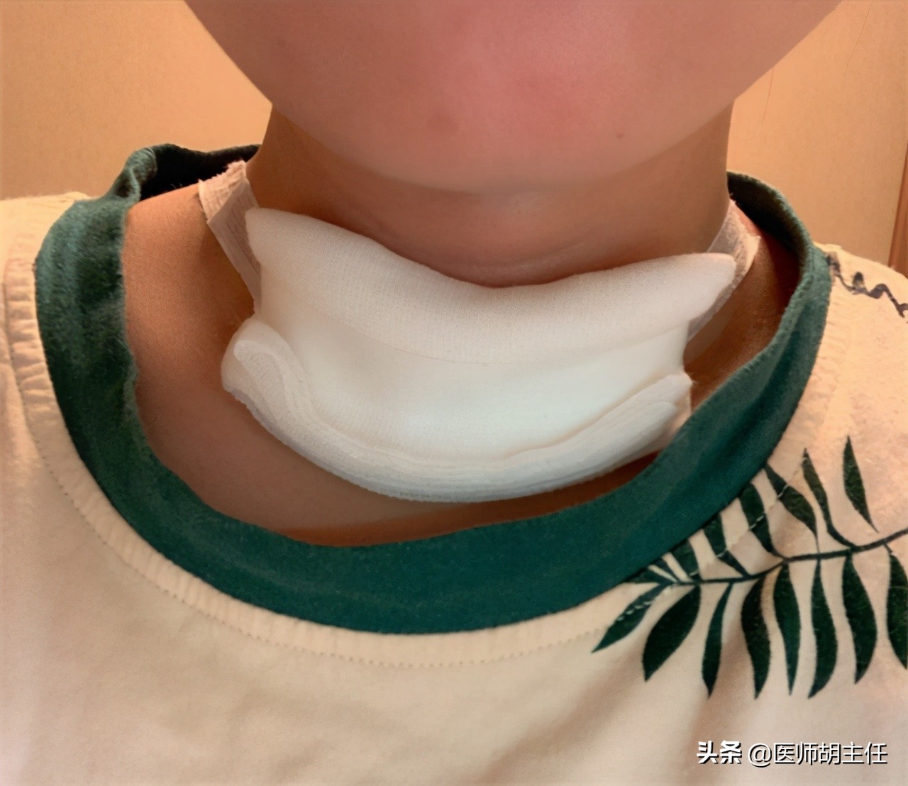 甲状腺全切是把甲状腺切除吗,甲状腺5级需要切除全部甲状腺吗