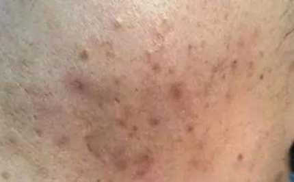 祛痘痘印最好最有效的方法,快速有效祛痘印的方法有什么