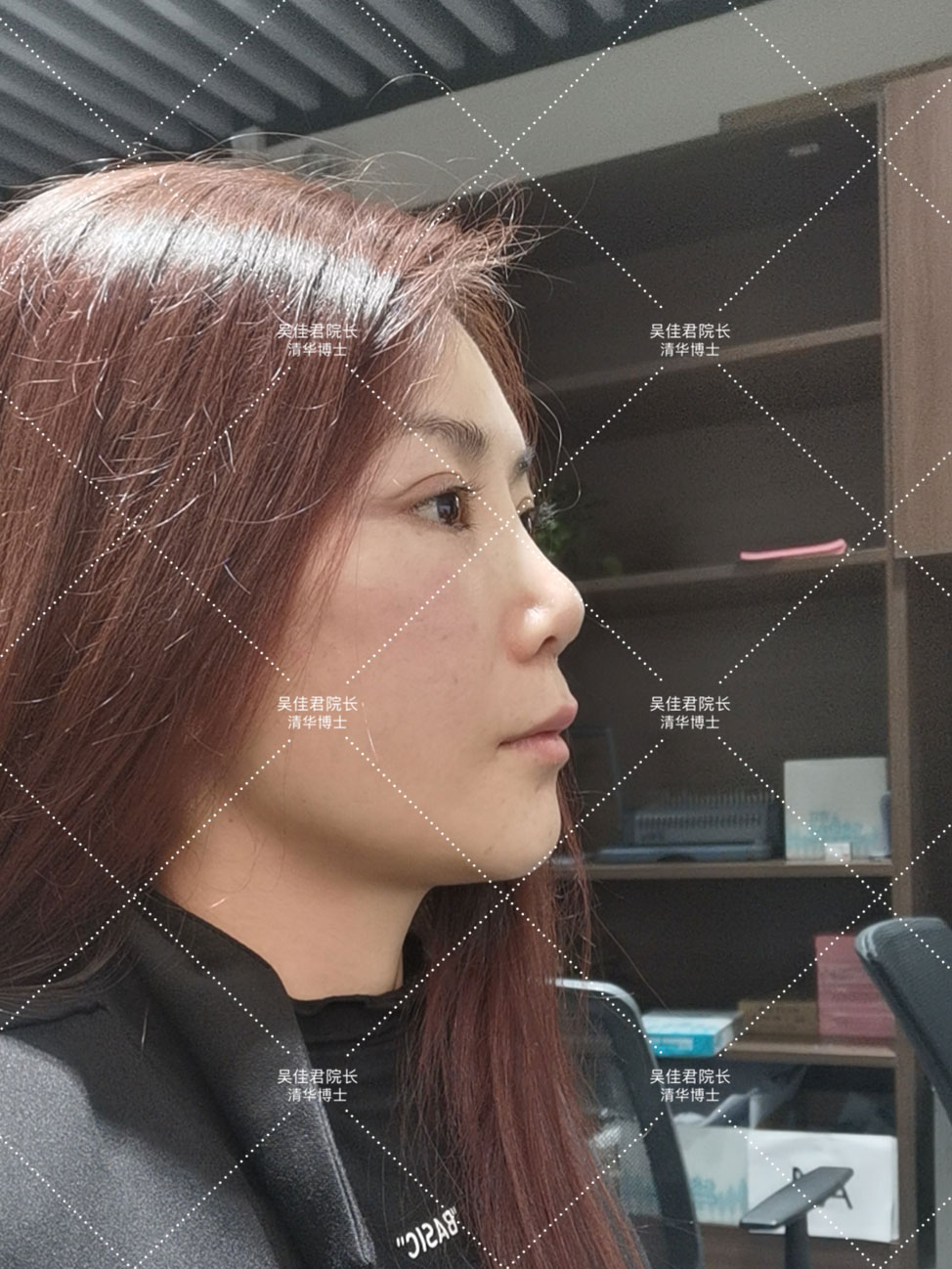 小拉皮术后恢复多久,小拉皮术后一个月发红