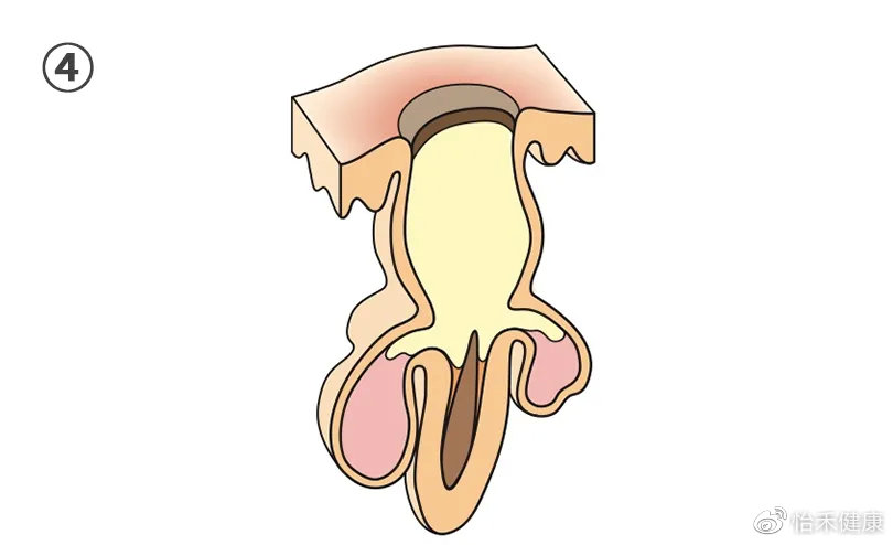 你以为的黑头真的是黑头吗,讨厌的黑头真的会变成草莓鼻吗
