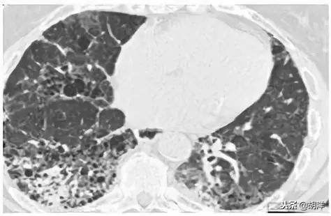 不输肺癌?得了间质性肺病真的只能活两三年吗?专家讲出大实话!