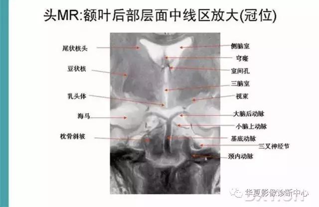 mra头颅解剖学详细讲解视频,常见的头颅mri图像