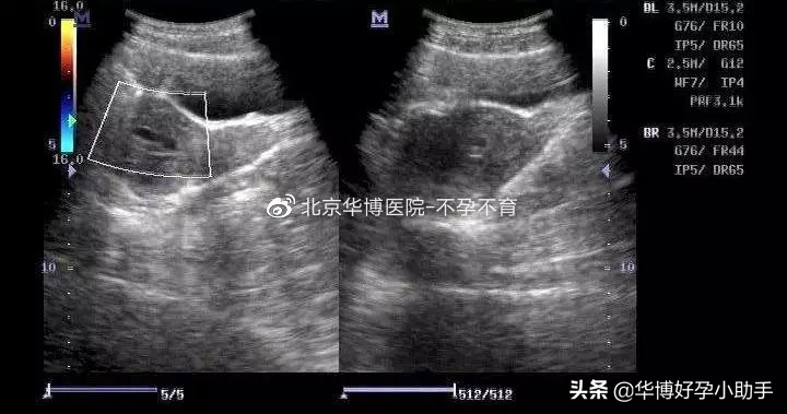 因为宫腔积液先兆流产严重吗,怀孕七周宫腔积液对胎儿有影响吗