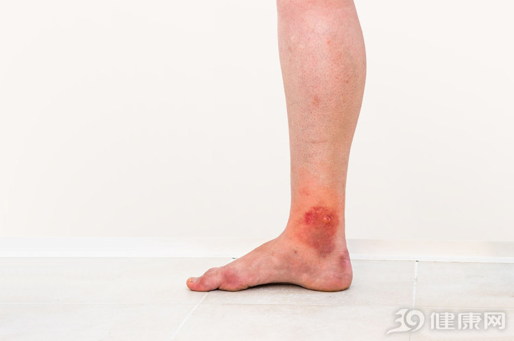 避免夏季蜱虫叮咬的10种方法,夏天蜱虫该不该直接拔