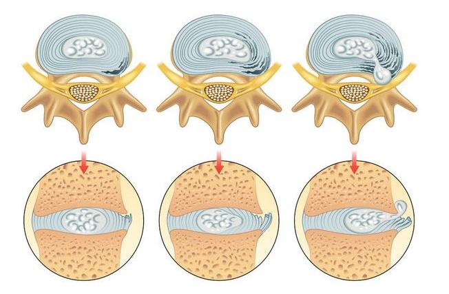 总是感觉腰疼腿酸怎么回事,腰疼屁股疼什么原因引起的