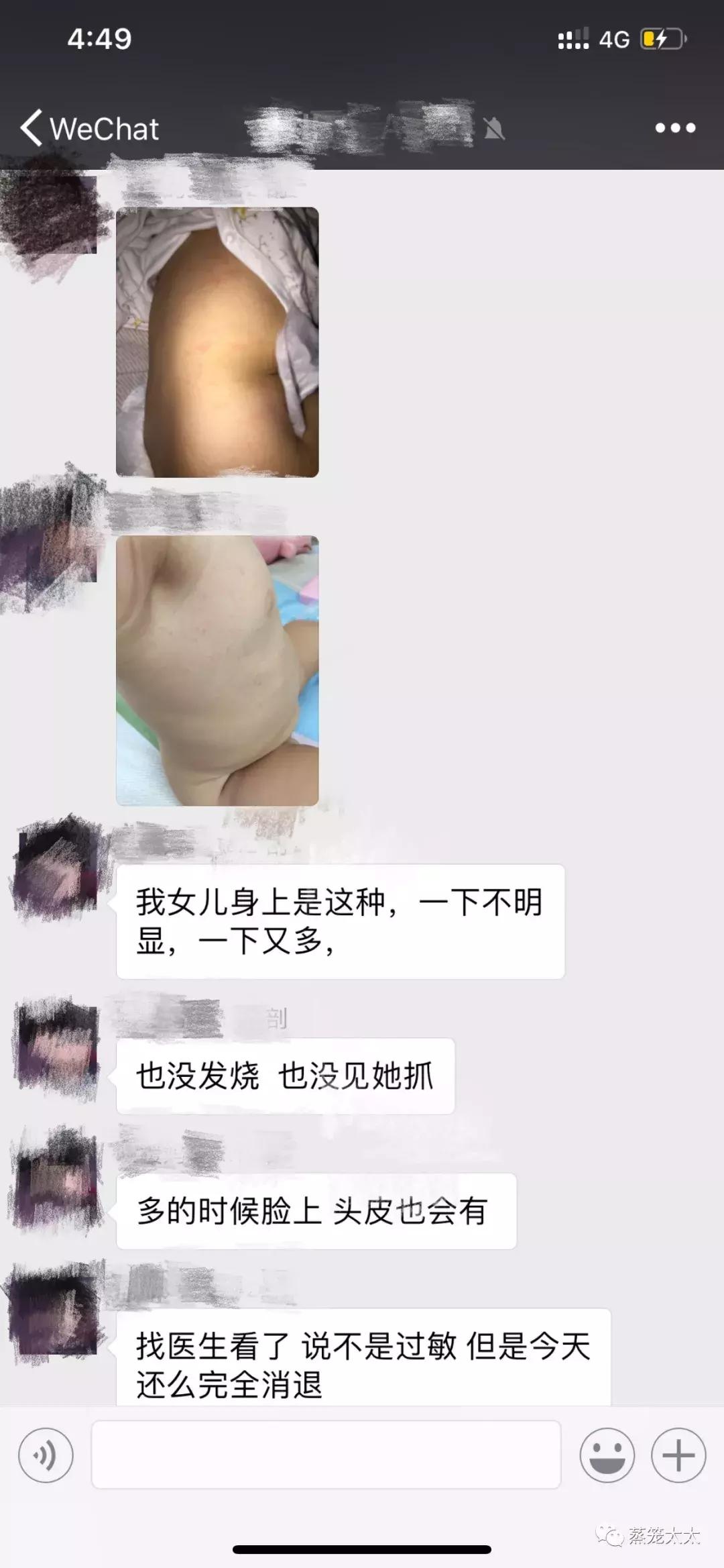 干性湿疹怎么护理和治疗,手湿疹怎么治疗和护理