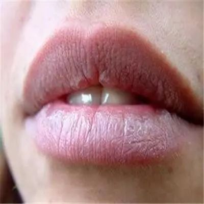 舔舔舔！唇炎找上门来怎么办？！