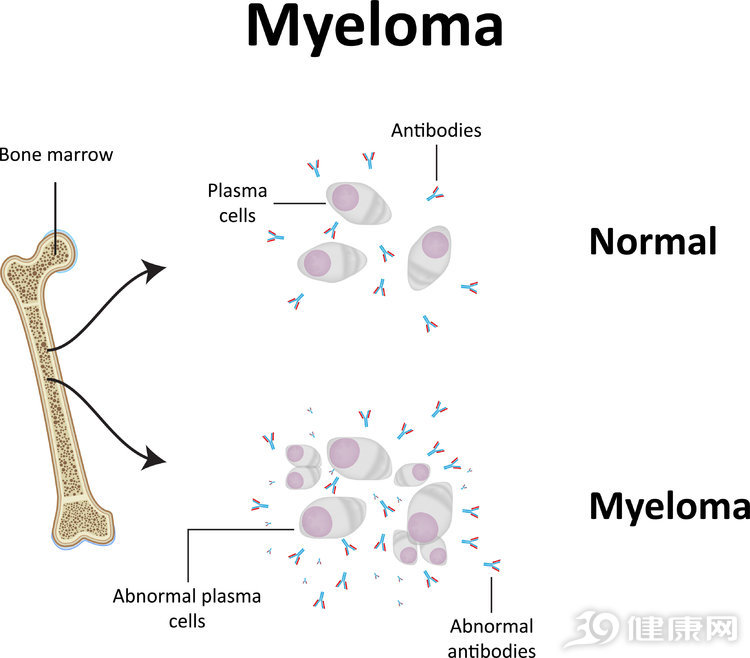 最难治的多发性骨髓瘤,最麻烦的血液病