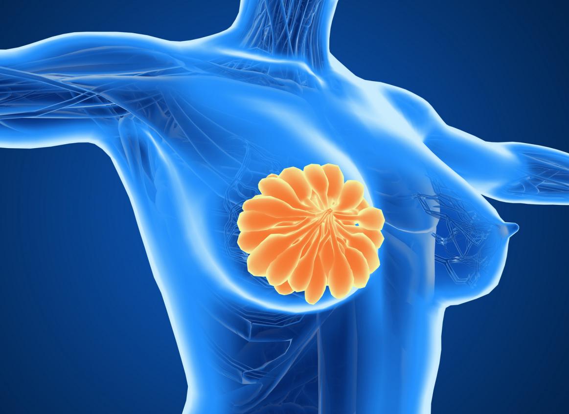 乳腺癌手术后乳房有鼓包,乳腺癌术后腋窝鼓包无痛怎么回事