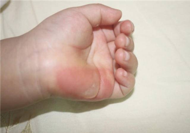 小孩热水烫伤长泡需要把泡刺破吗,小孩烫到起泡多久会恢复