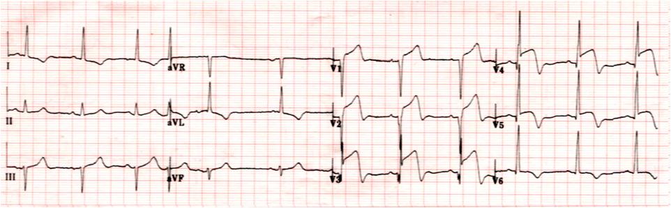 急性心肌梗死的做法,内科主治心肌梗死视频