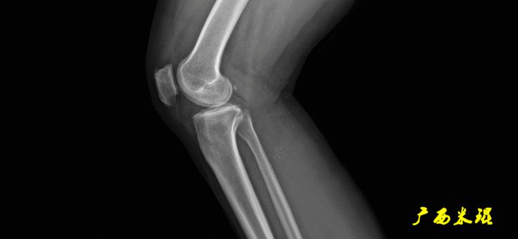 广西骨科医生米琨最新信息,米琨广西骨科什么水平