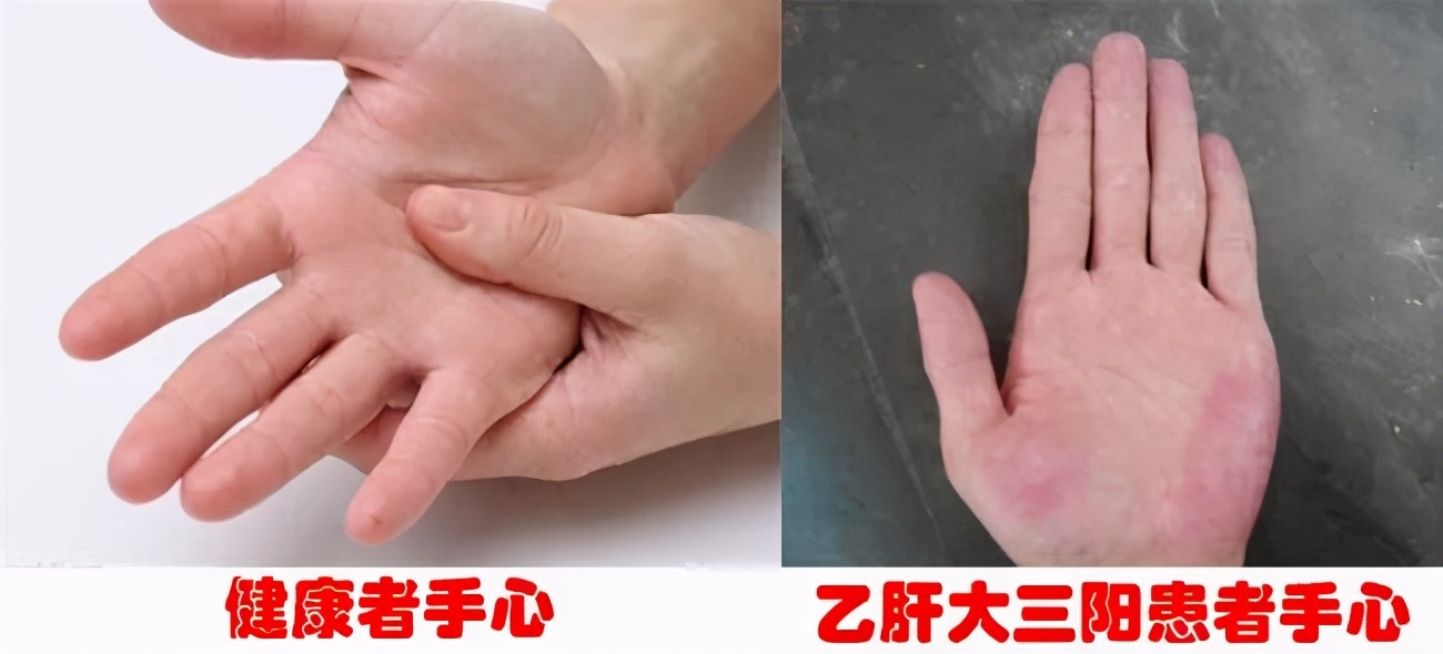 乙肝出现了蜘蛛痣和肝掌能治疗吗,乙肝携带者肝功能正常会有肝掌吗