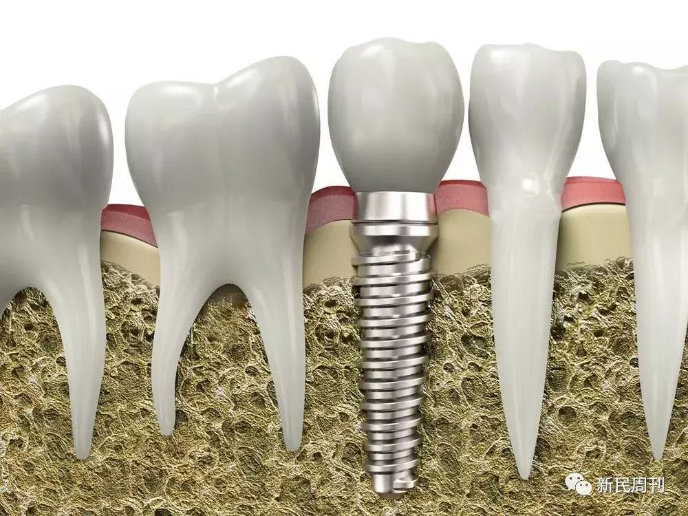 一口牙齿全国种植要多少钱,种植一口牙价格表