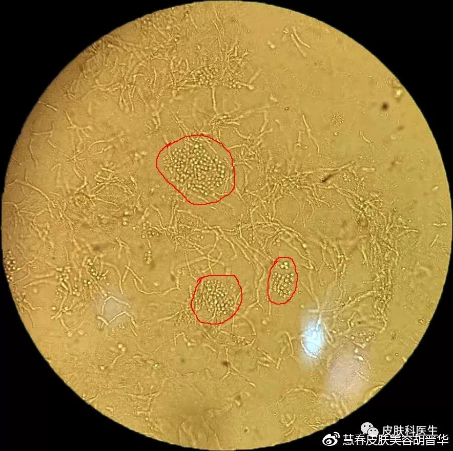 是湿疹或癣医生一眼就能辨出来吗,是不是体癣怎么检查