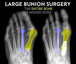 拇外翻大脚趾疼如何在家就能治,大脚拇指痛要警惕