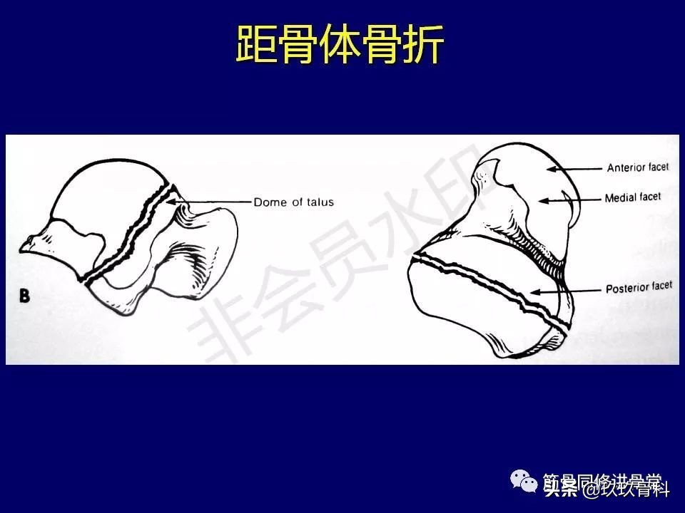 距骨骨折的治疗原则,距骨骨折如何调理